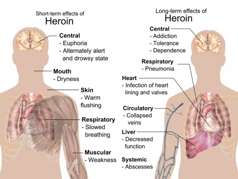 effects of heroin image