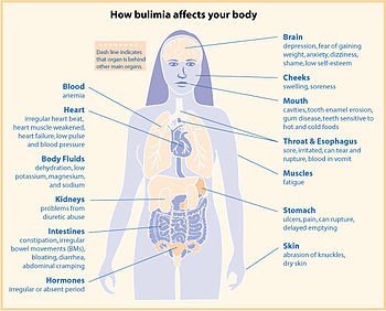 image showing how bulimia affects our bodies