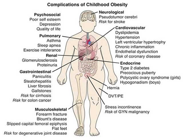 childhood obesity chart